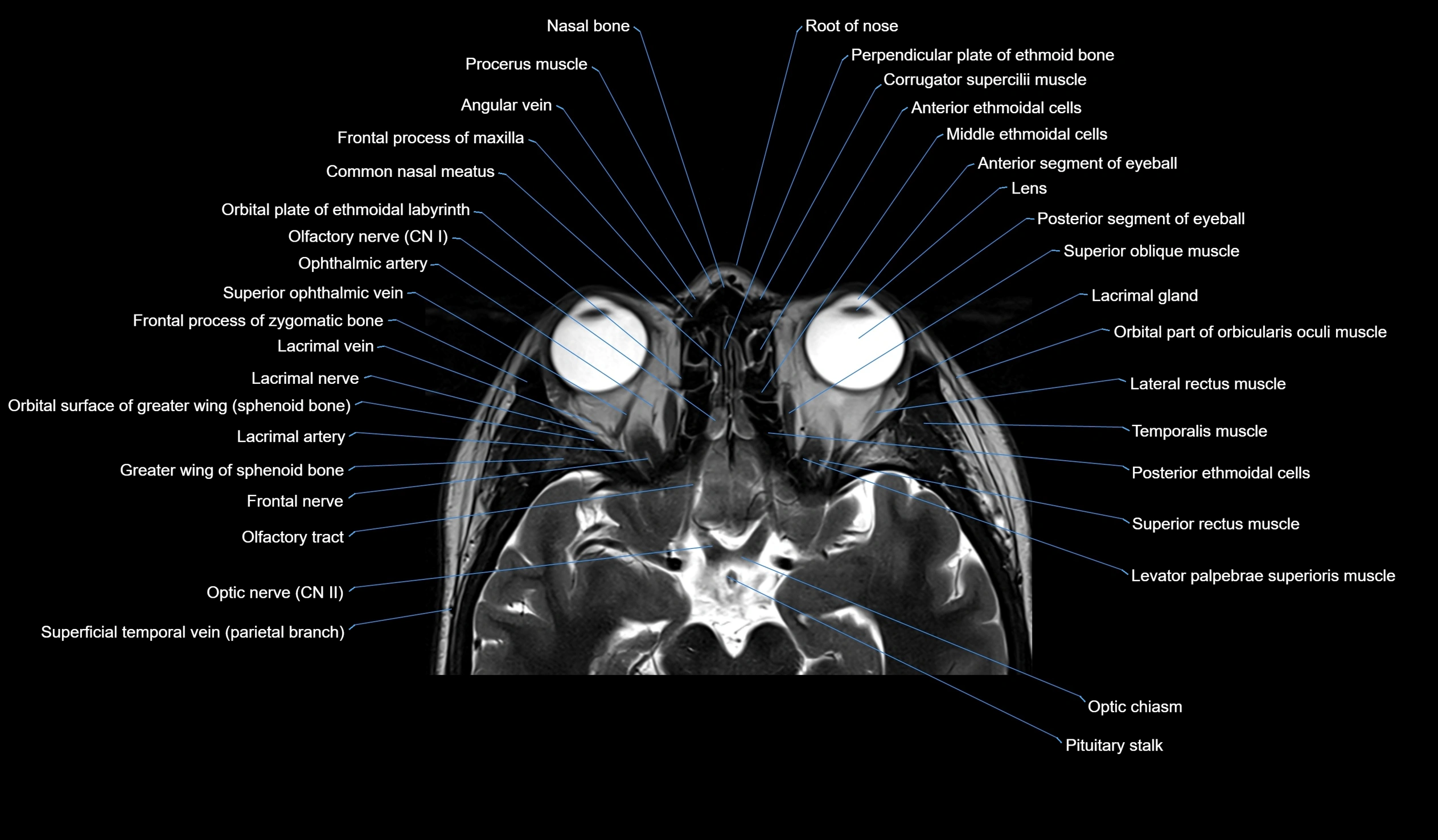 MRI face & paranasal sinuses(PNS) labelled  coronal  cross sectional anatomy 3T radiology  image-img-00001-00023.webp